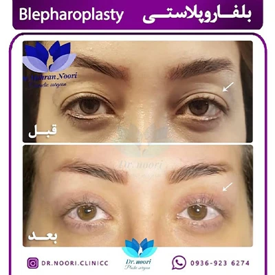 نتیجه بلفاروپلاستی