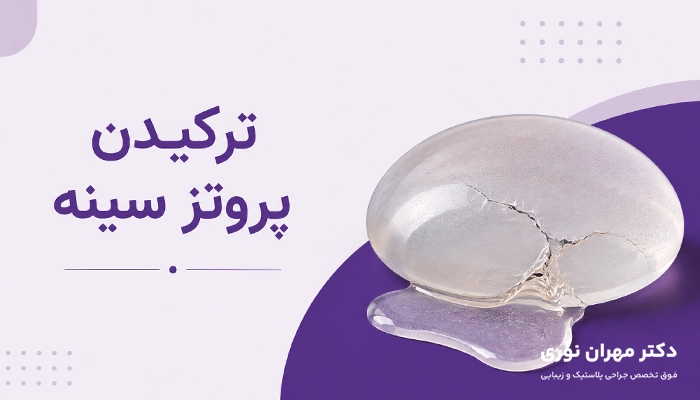 ترکیدن پروتز سینه