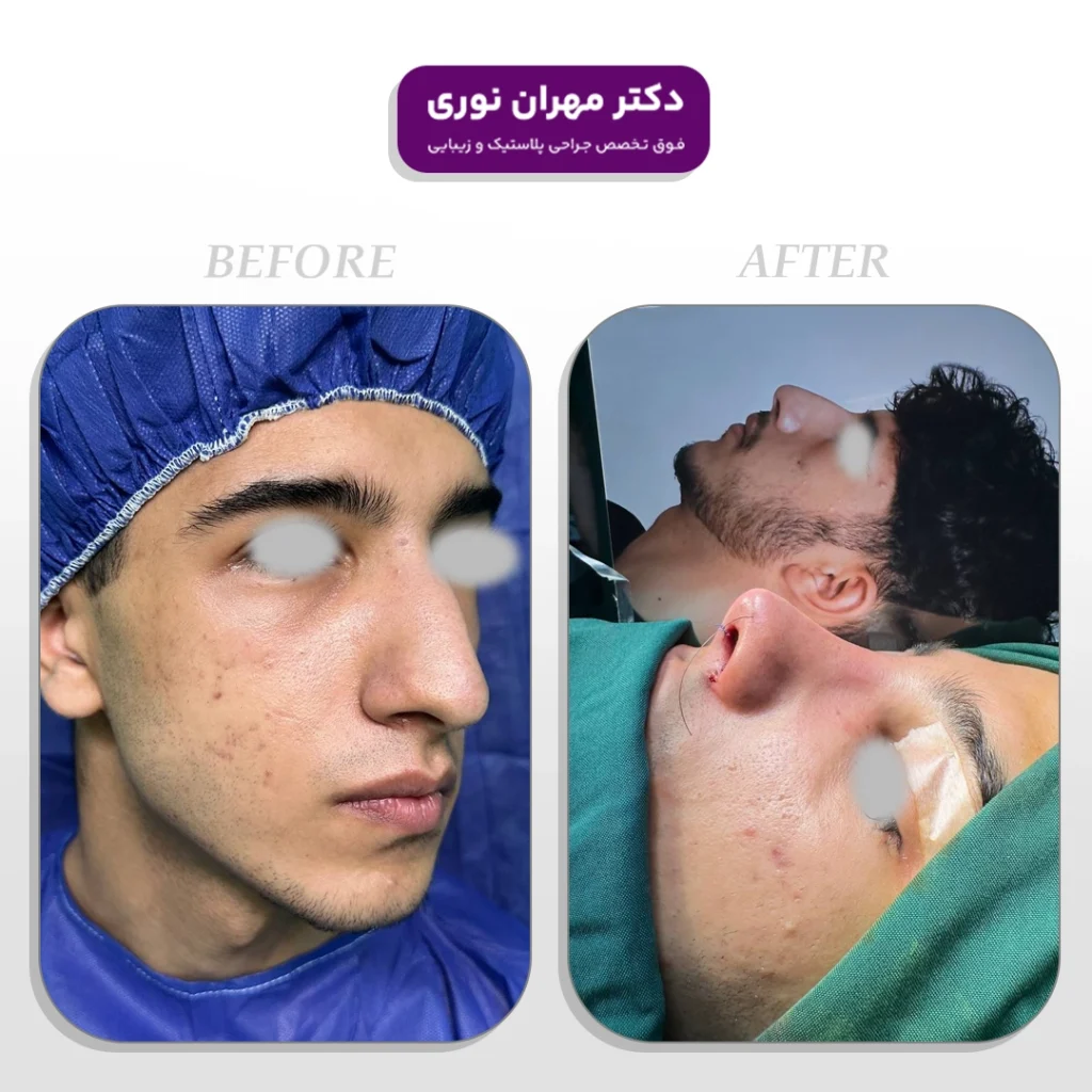 جراحی زیبایی بینی توسط دکتر مهران نوری جراح پلاستیک