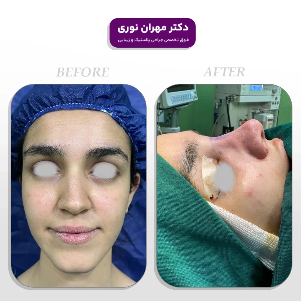 عمل زیبایی بینی دکتر مهران نوری