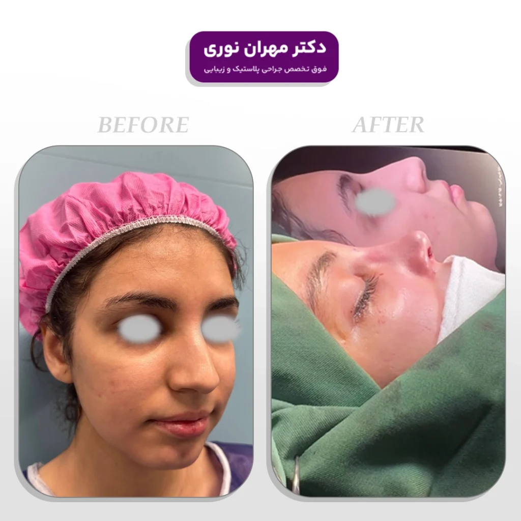 نمون عمل زیبایی بینی دکتر نوری
