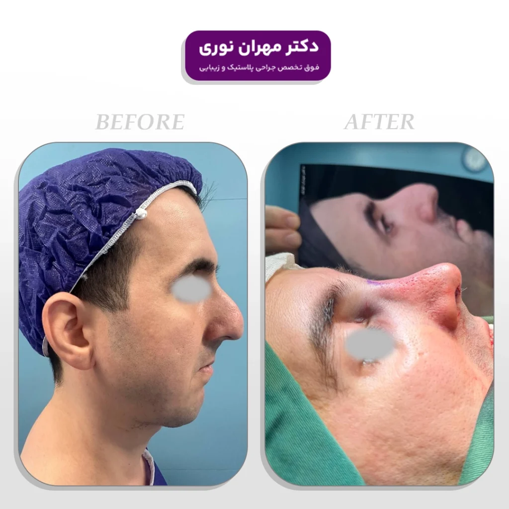 نمونه عمل جراحی زیبایی بینی دکتر مهران نوری