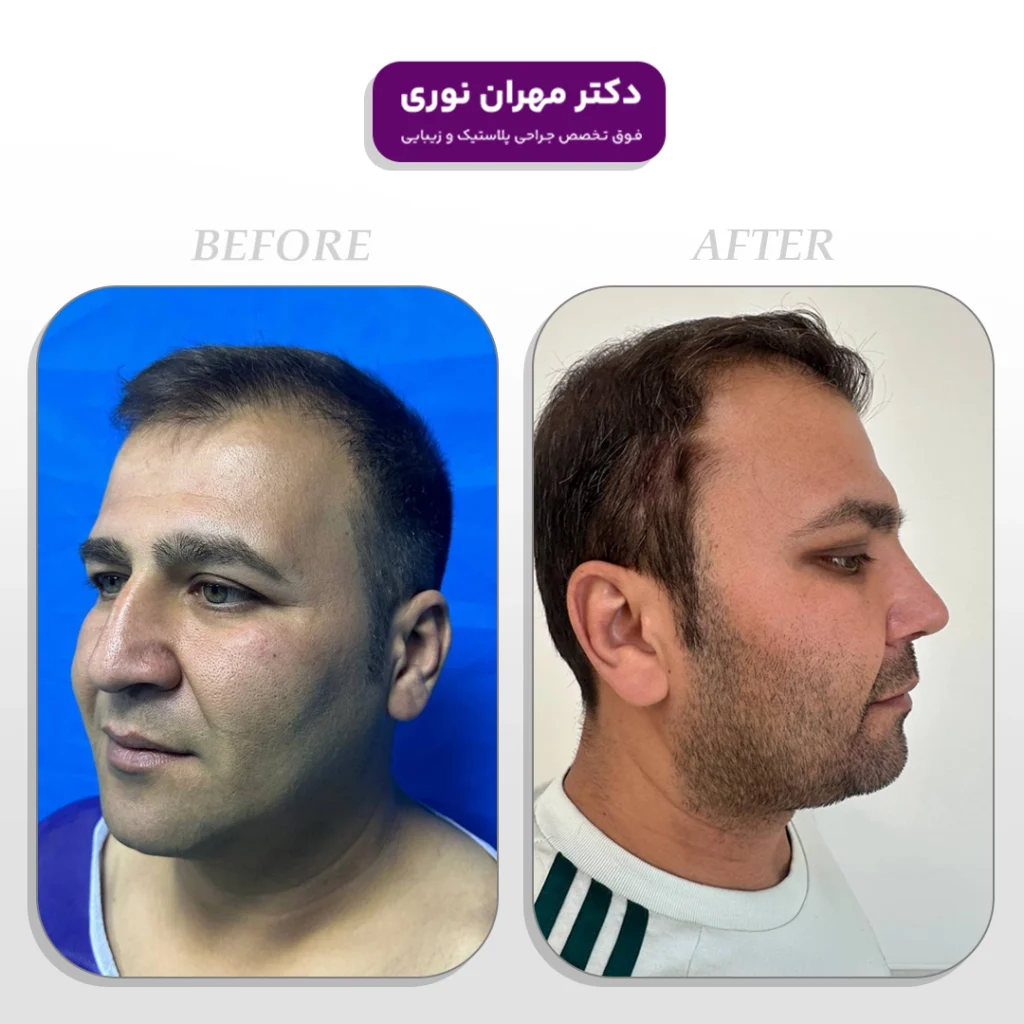 نمونه کار جراحی بلفاروپلاستی و بینی