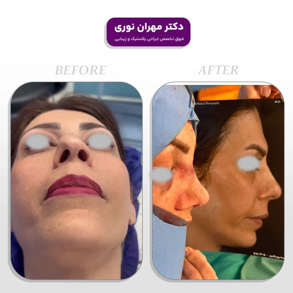نمونه کار جراحی بینی دکتر مهران نوری