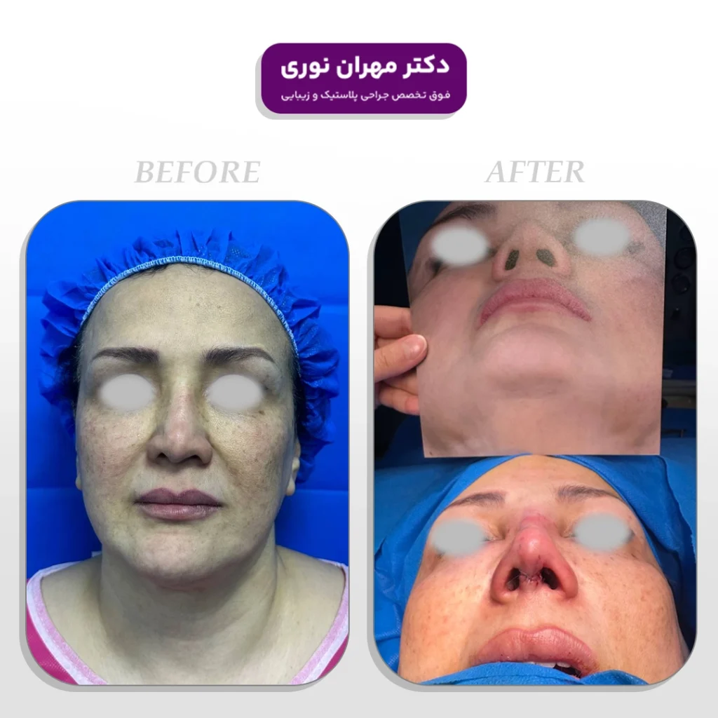 نمونه کار عمل بینی