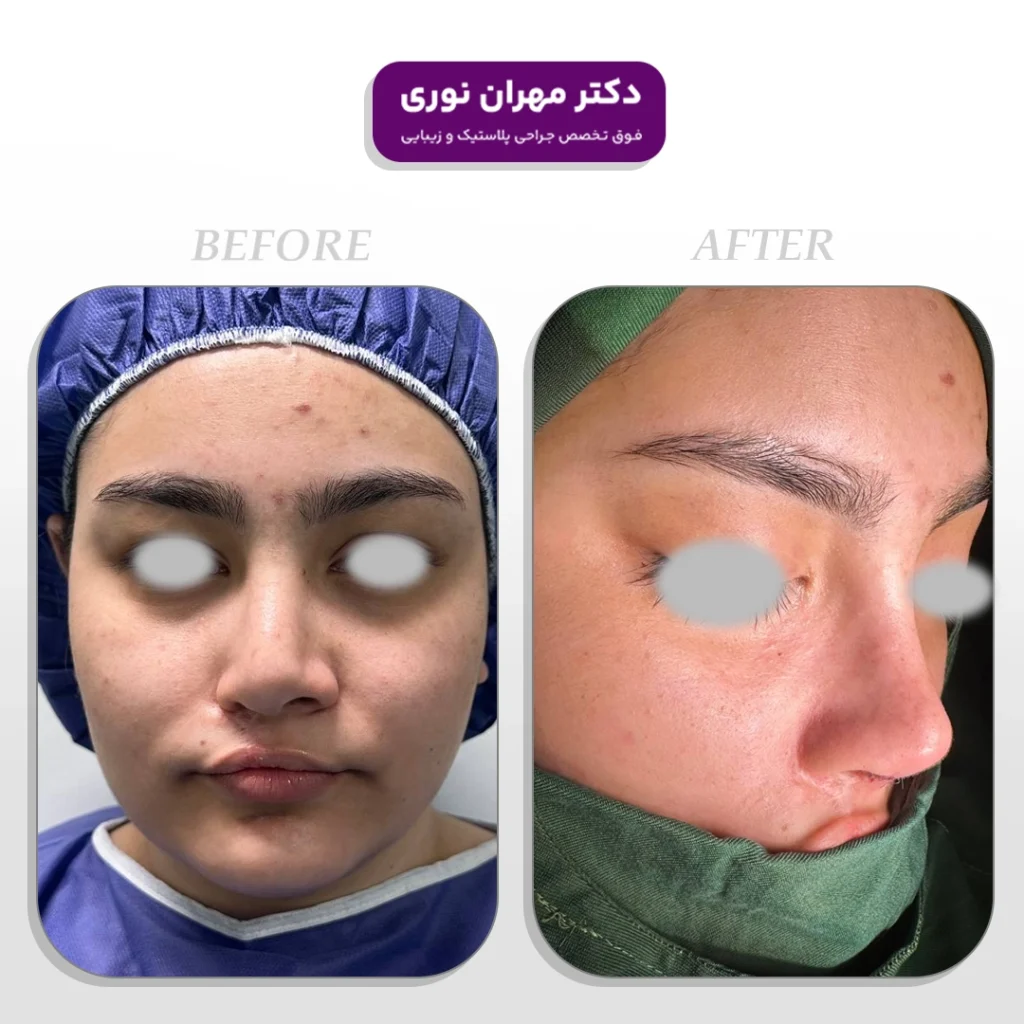 نمونه کار عمل زیبایی بینی توسط دکتر مهران نوری