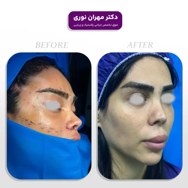 لیفت شقیقه