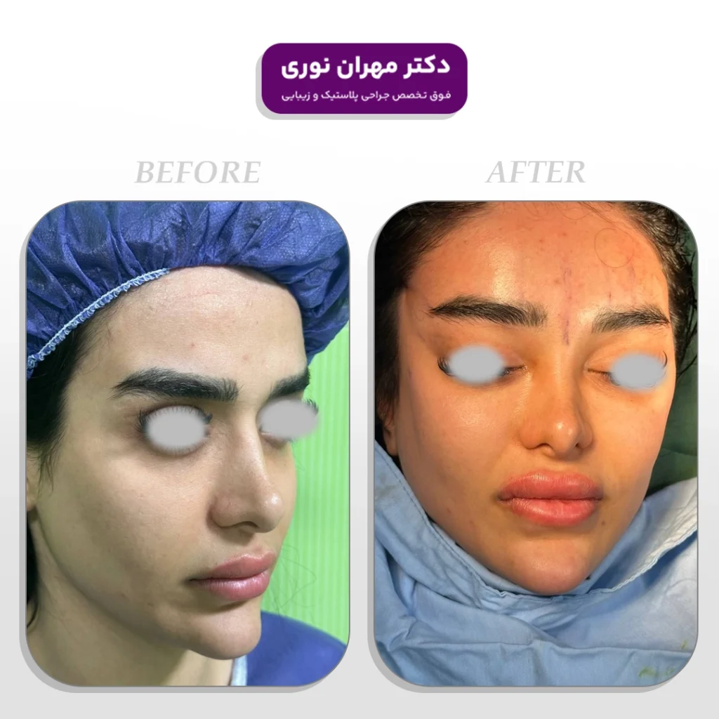 جراحی لیفت شقیقه